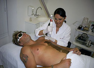 Vale a pena investir em uma depilação a laser para homens? Eficiência da depilação a laser masculina