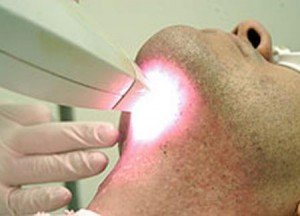 Depilação a laser para barba Depilar barba