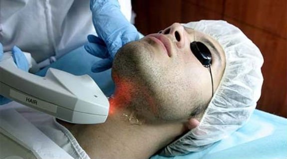 Depilação a laser masculina Depilação definitiva masculina