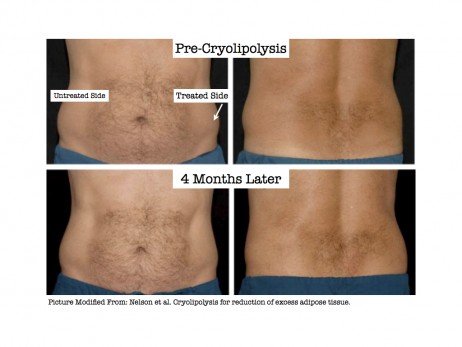 O antes e o depois da criolipólise Efeitos da criolipólise