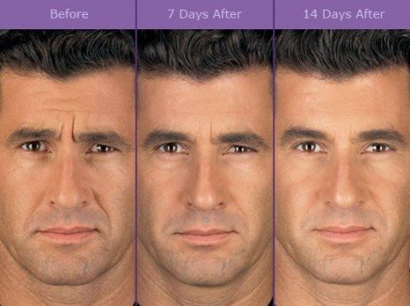 Não exagere no uso do Botox! Problemas com Botox