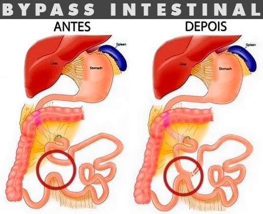 Como é a cirurgia de bypass intestinal