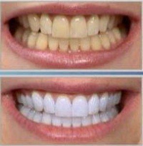 Resultado clareamento dos dentes