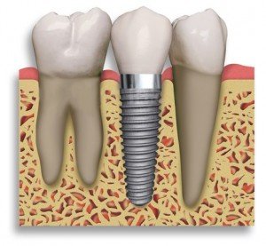 Implante dentário