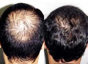 Resultado do microimplante
