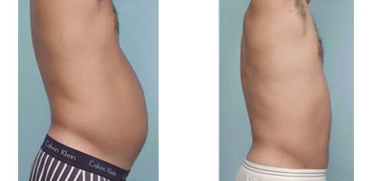 Cirurgia de Abdominoplastia masculina
