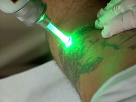 Como tirar tatuagem definitiva