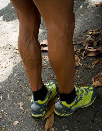 Tratamento para varizes em homens