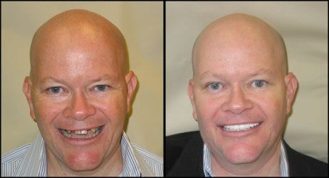 Antes e depois implante