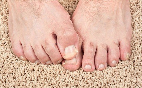 Unhas feias nos pés masculinos
