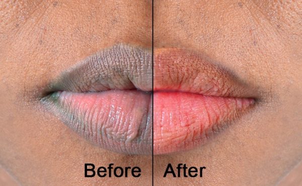 Clareamento labial
