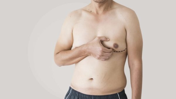 Cirurgia de ginecomastia