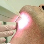Depilação masculina a laser: definitiva para barba