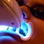 Clareamento dentário: saiba antes de fazer!
