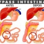 O que é Bypass intestinal? Funciona?